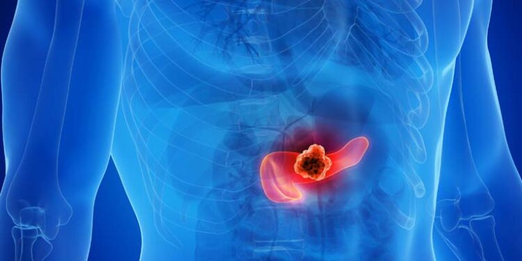 Kræft i bugspytkirtlen -cover